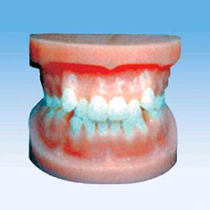 Rectify deformity teeth model